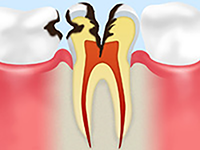 後期の虫歯